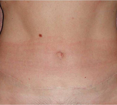 Abdominoplastie3-na