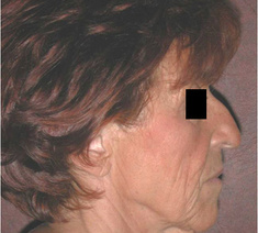 Facelifting20-voor