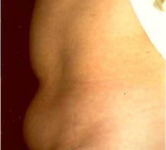 Abdominoplastie4-voor