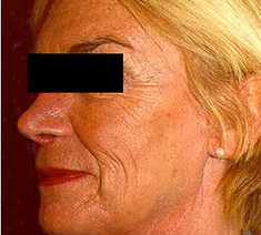 Facelifting6-voor