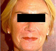 Facelifting5-voor