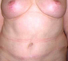 Abdominoplastie5-na