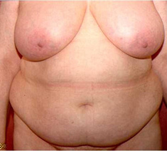 Abdominoplastie5-voor