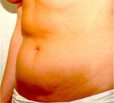 Abdominoplastie6-voor