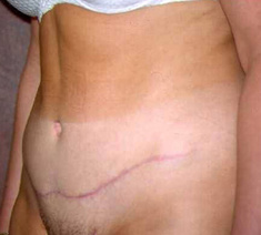 Abdominoplastie6-na