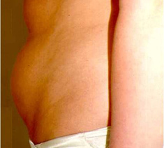 Abdominoplastie7-voor