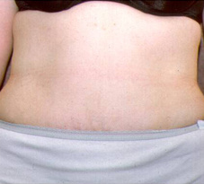 Abdominoplastie8-na