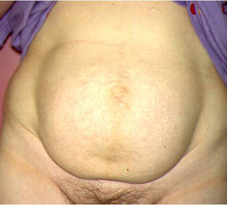 Abdominoplastie8-voor