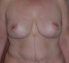 Abdominoplastie11-na