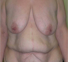 Abdominoplastie11-voor